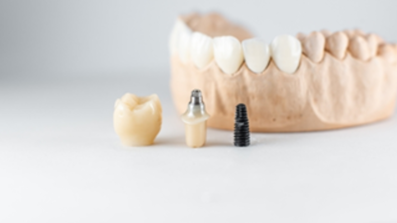 How Long Do Dental Implants Last on Average?